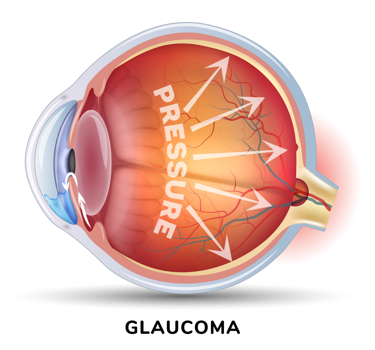 Glaucoma와 안압의 상관관계